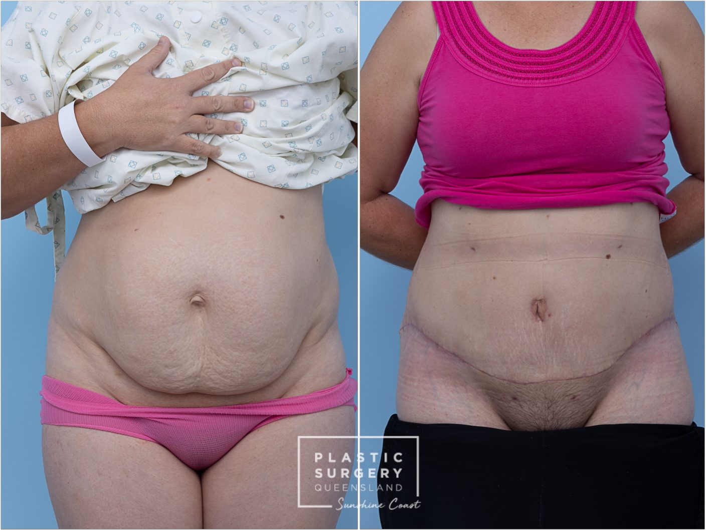 Abdominoplasty result, front view — non-identifying