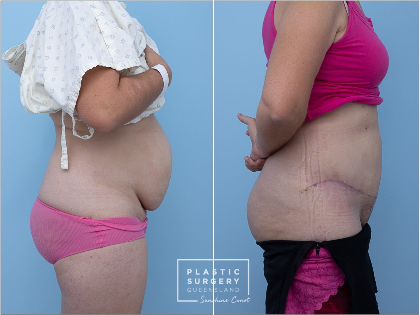 Abdominoplasty (Tummy Tuck) — clinical photograph (non-identifying)