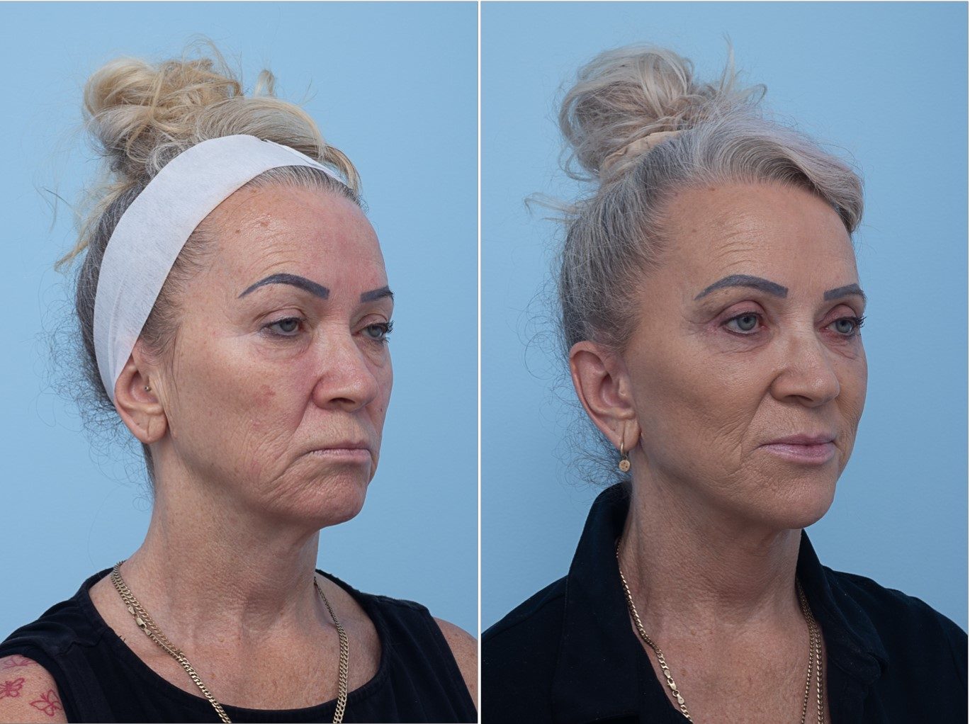Upper blepharoplasty result, oblique view — non-identifying
