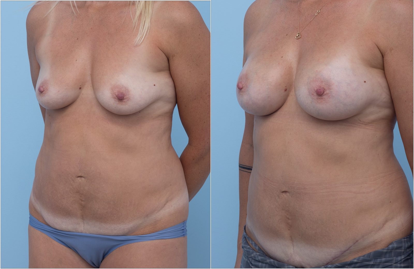 Breast Augmentation — clinical photograph (non-identifying)