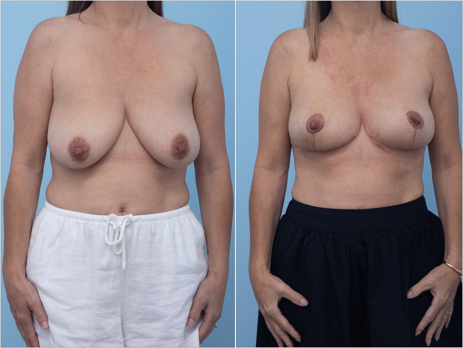 Breast reduction result, front view — non-identifying