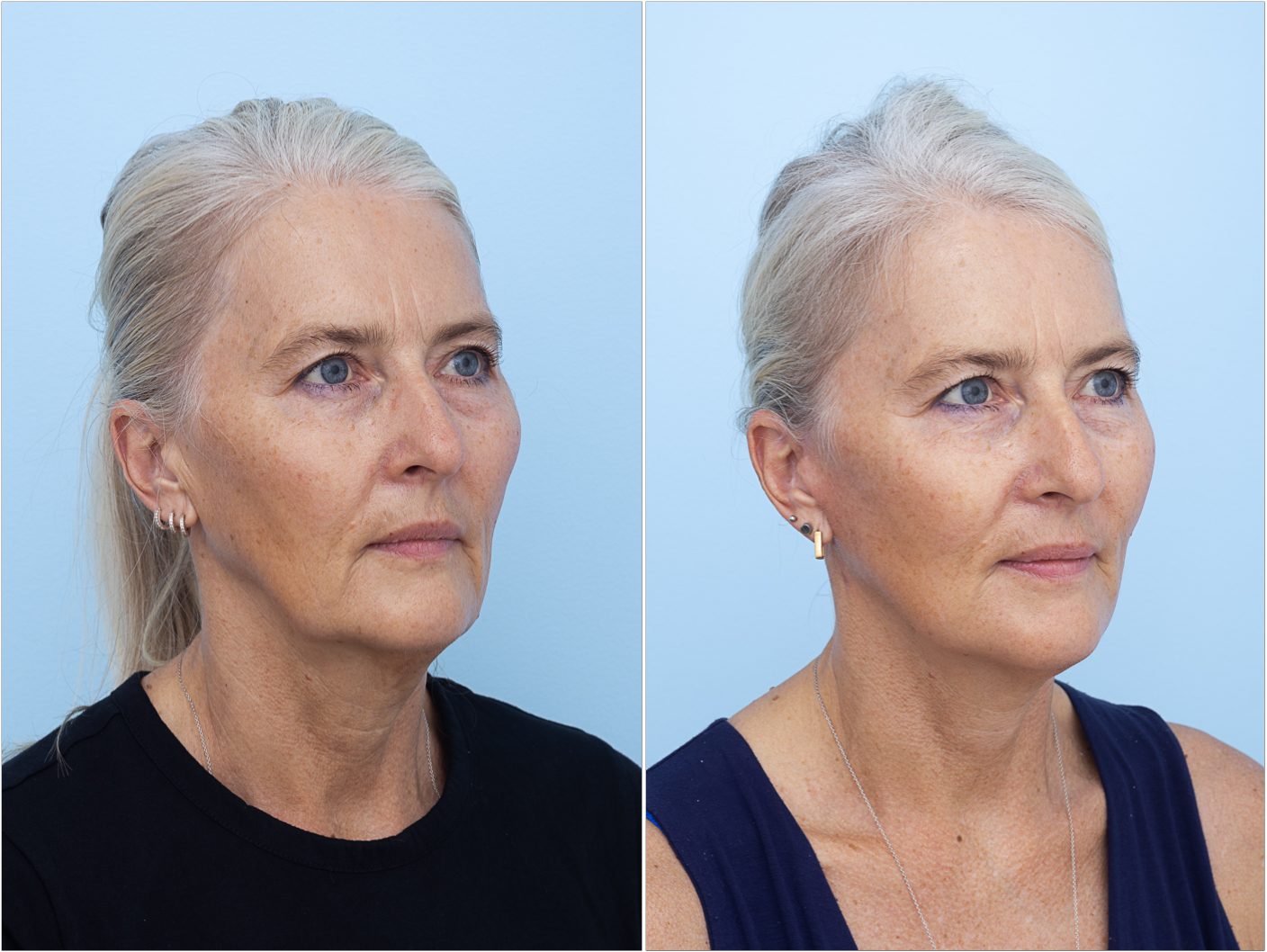 Facelift result, oblique view — non-identifying