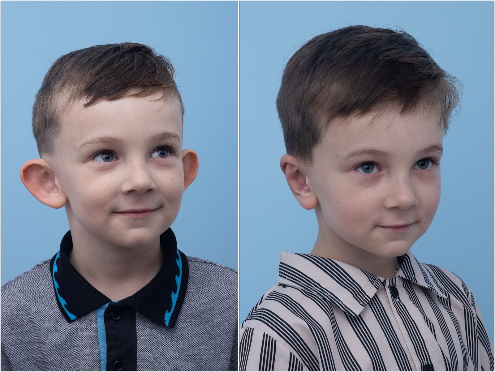 Ear Surgery (Otoplasty) — clinical photograph (non-identifying)